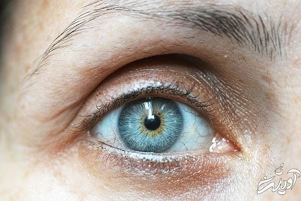 درمان سیاهی زیر چشم